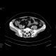 Epiploic appendagitis: CT - Computed tomography
